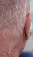 fertige Ohr-Epithese am Patienten