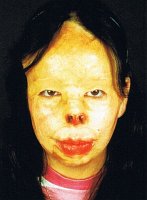 Patient B.S, 17 Jahre, weiblich, Brandverletzung des Gesichtes mit Teilverlust der Nasenspitze und der Nasenflügel